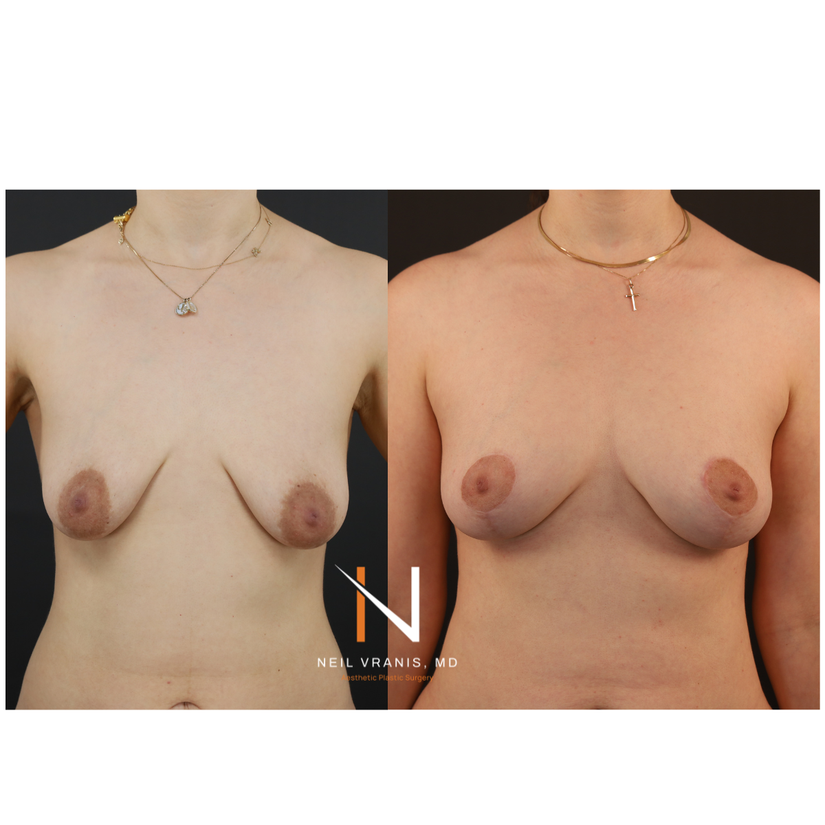 Dr. Neil Vranis Mommy Makeover Before and After Picture