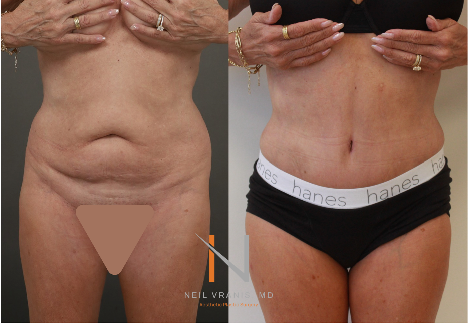 Dr. Neil Vranis Mommy Makeover Before and After Picture