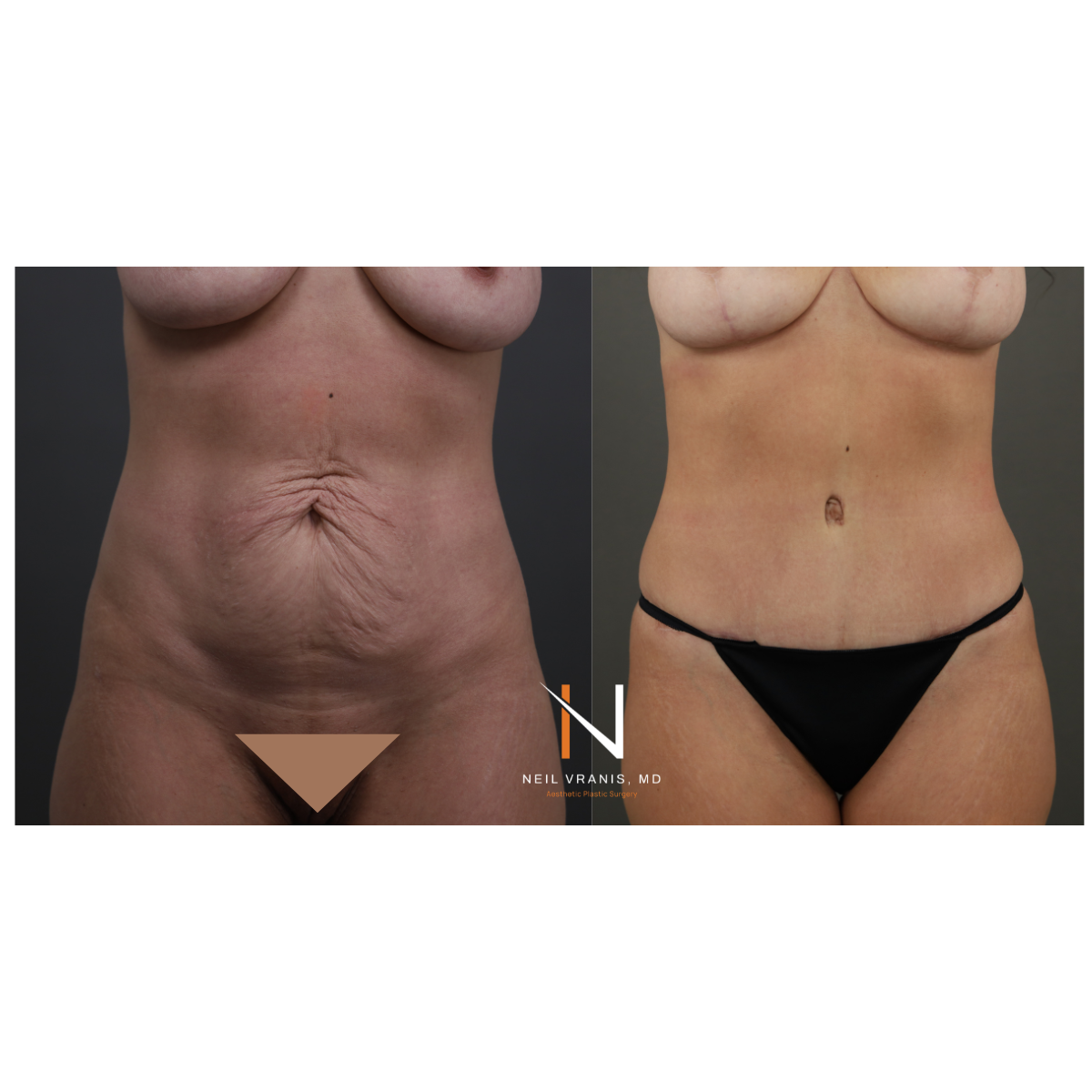 Dr. Neil Vranis Mommy Makeover Before and After Picture