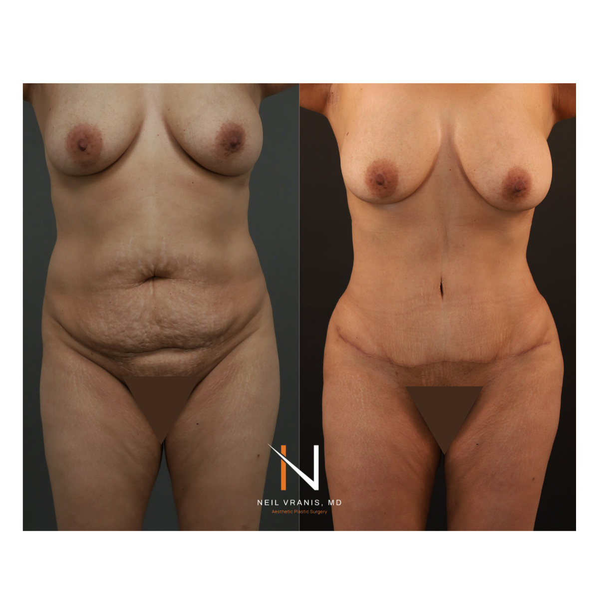 Dr. Neil Vranis Mommy Makeover Before and After Picture