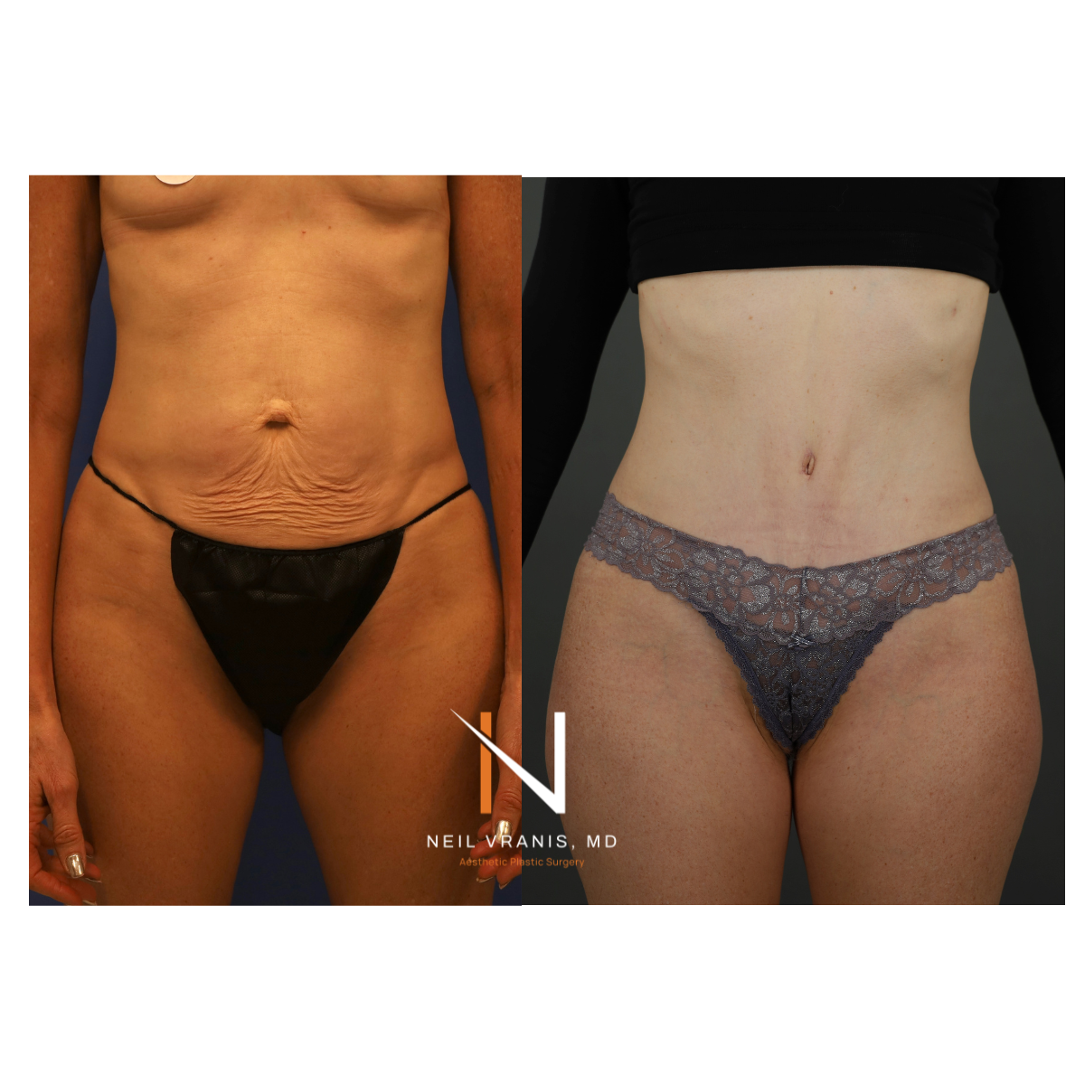 Dr. Neil Vranis Mommy Makeover Before and After Picture