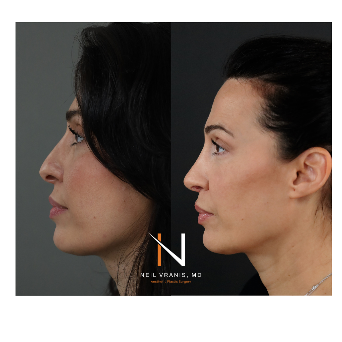 Dr. Neil Vranis Rhinoplasty Before and After Picture