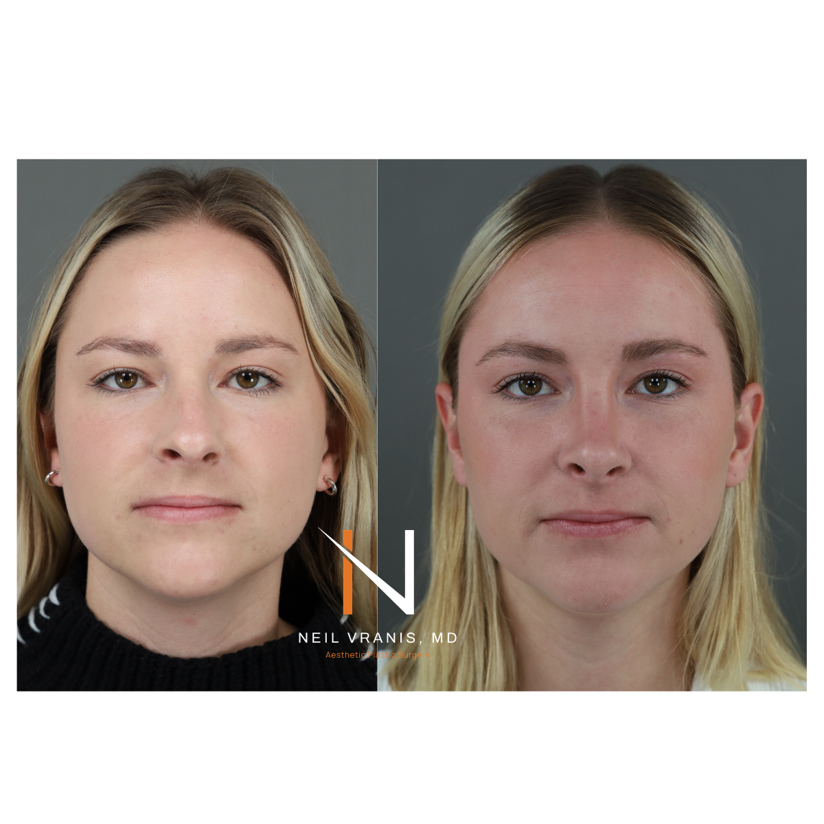 Dr. Neil Vranis Rhinoplasty Before and After Picture