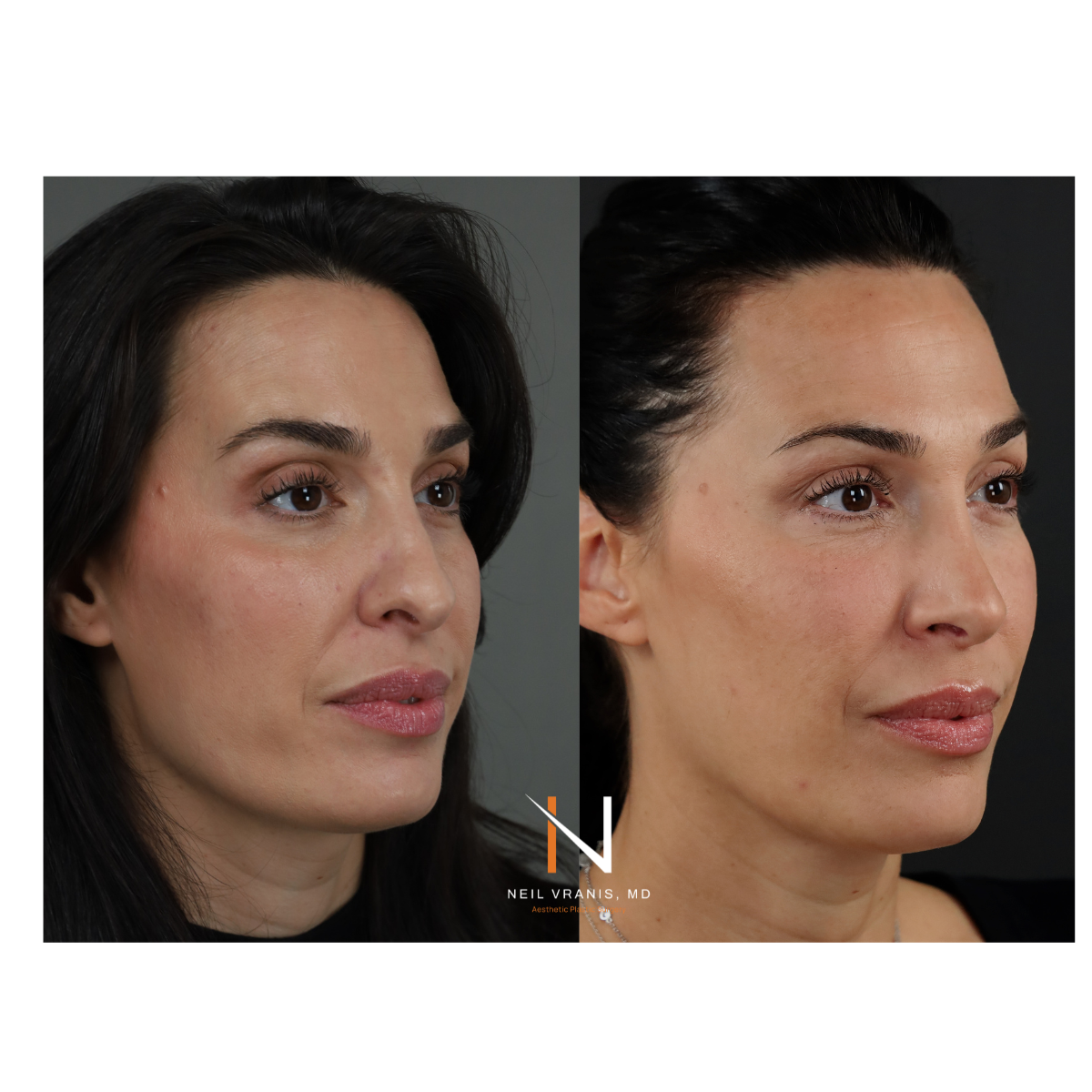 Dr. Neil Vranis Rhinoplasty Before and After Picture