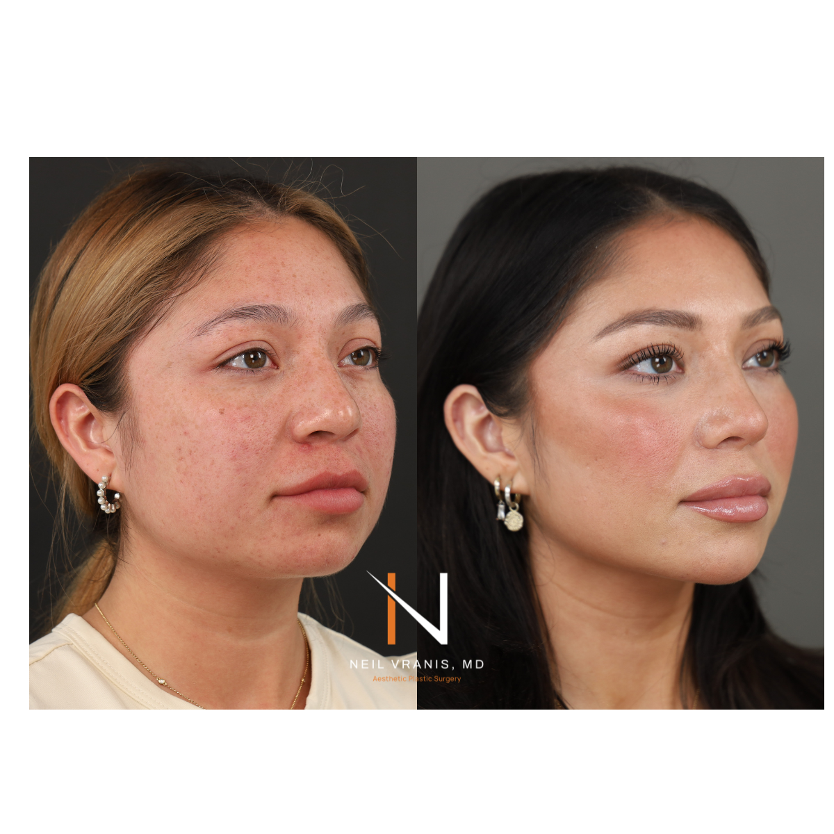 Dr. Neil Vranis Rhinoplasty Before and After Picture