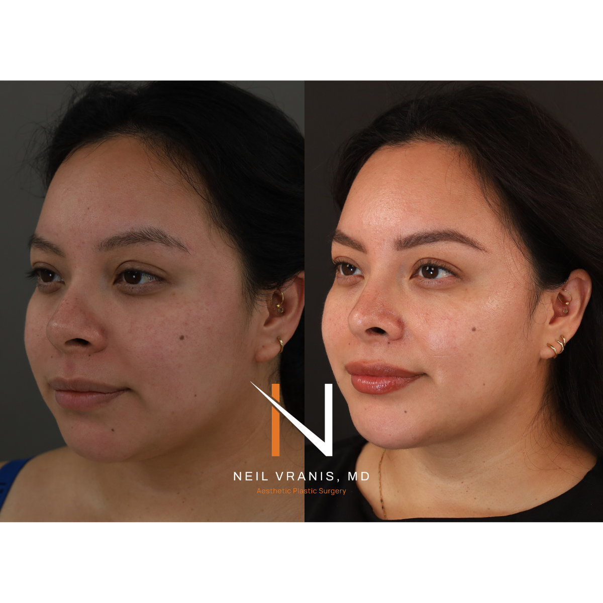 Dr. Neil Vranis Rhinoplasty Before and After Picture