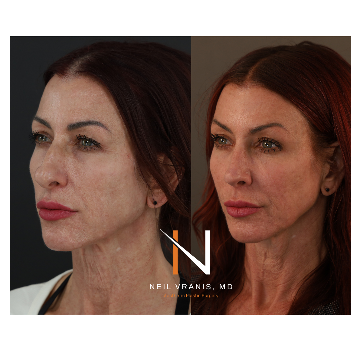 Dr. Neil Vranis Rhinoplasty Before and After Picture
