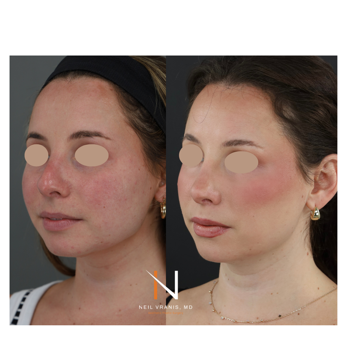 Dr. Neil Vranis Rhinoplasty Before and After Picture