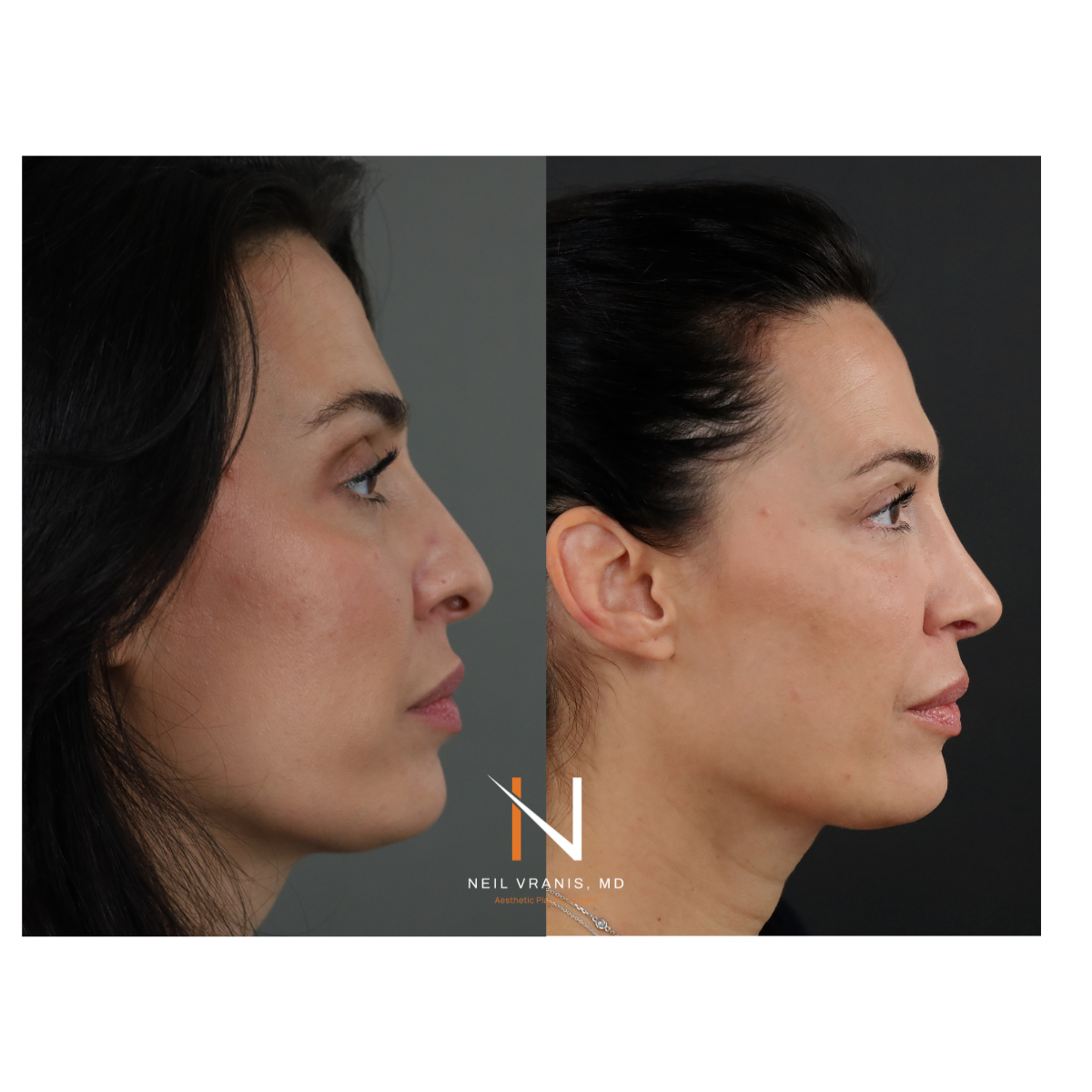 Dr. Neil Vranis Rhinoplasty Before and After Picture