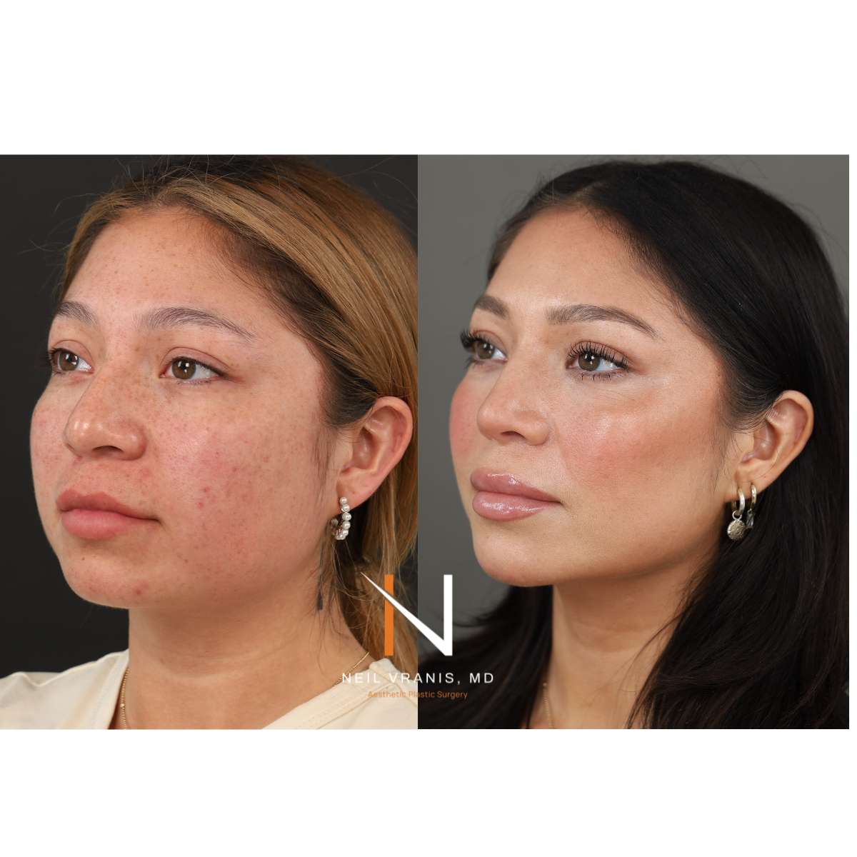 Dr. Neil Vranis Rhinoplasty Before and After Picture