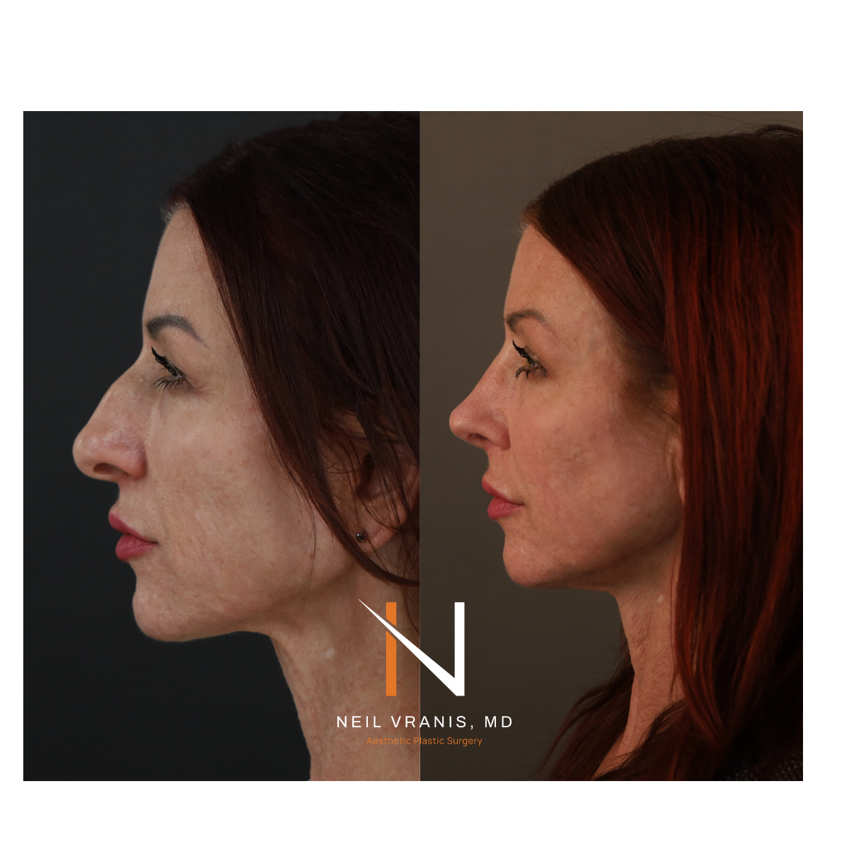 Dr. Neil Vranis Rhinoplasty Before and After Picture
