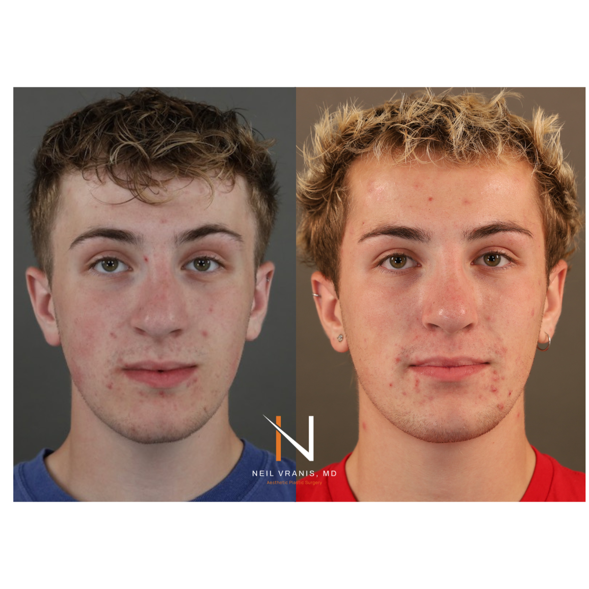 Dr. Neil Vranis Rhinoplasty Before and After Picture