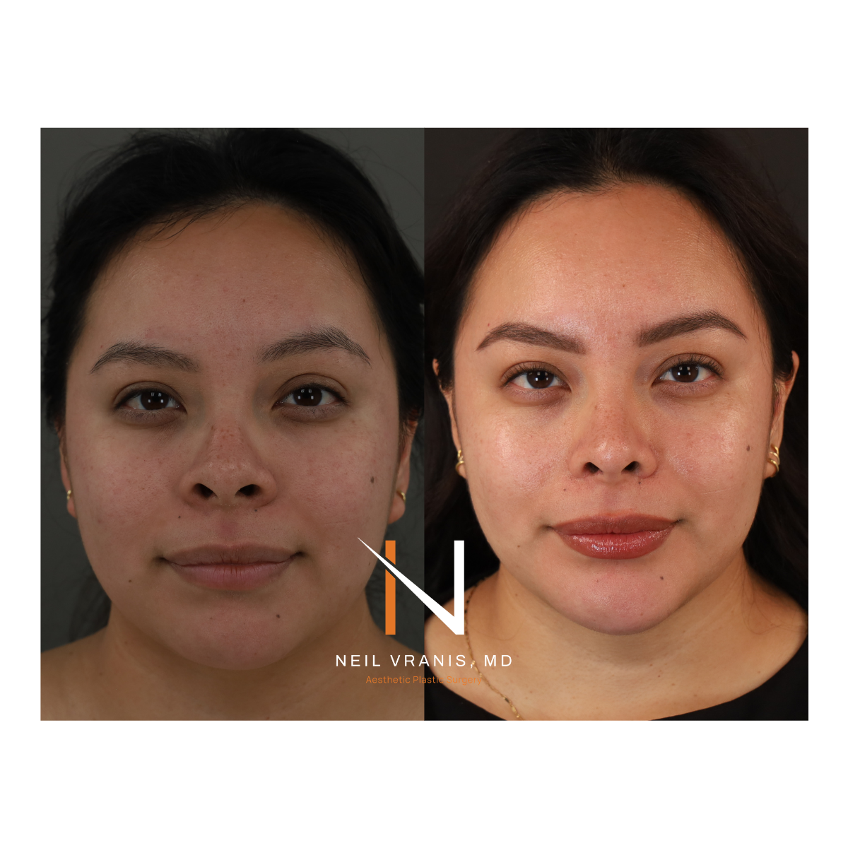 Dr. Neil Vranis Rhinoplasty Before and After Picture