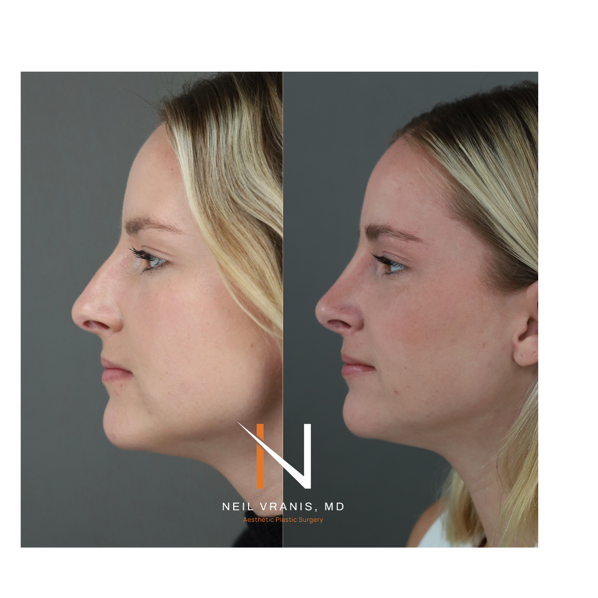 Dr. Neil Vranis Rhinoplasty Before and After Picture
