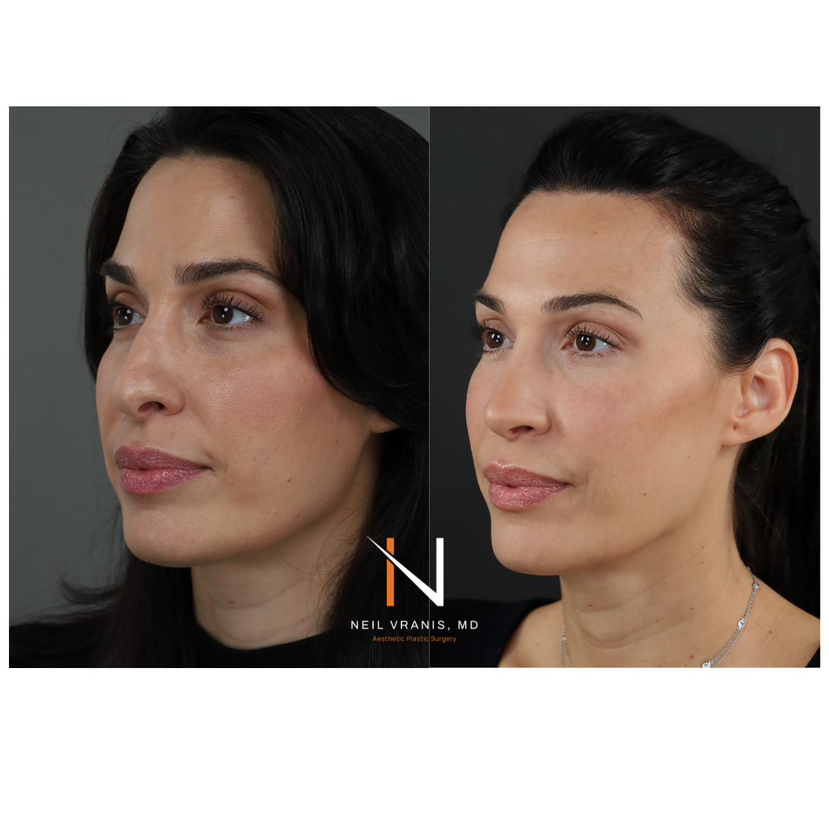 Dr. Neil Vranis Rhinoplasty Before and After Picture