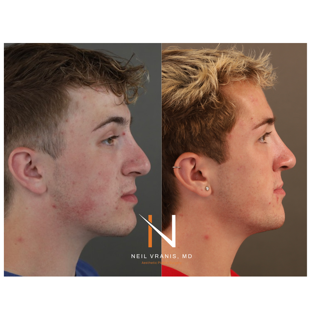Dr. Neil Vranis Rhinoplasty Before and After Picture