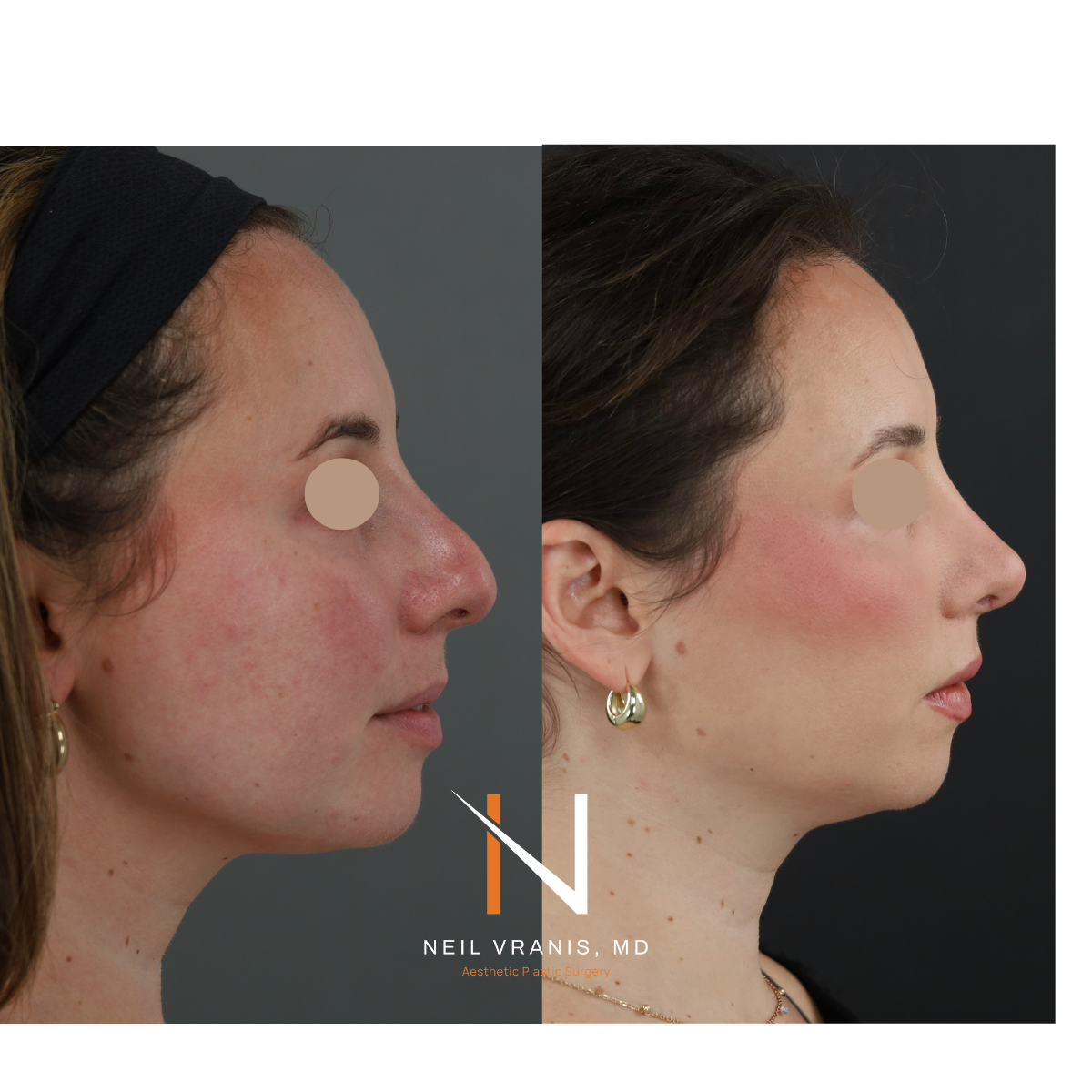 Dr. Neil Vranis Rhinoplasty Before and After Picture