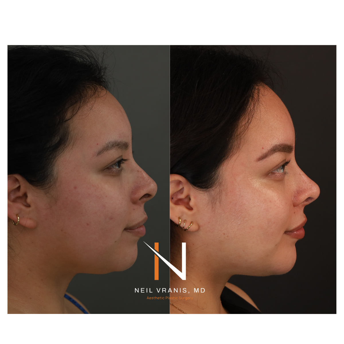 Dr. Neil Vranis Rhinoplasty Before and After Picture