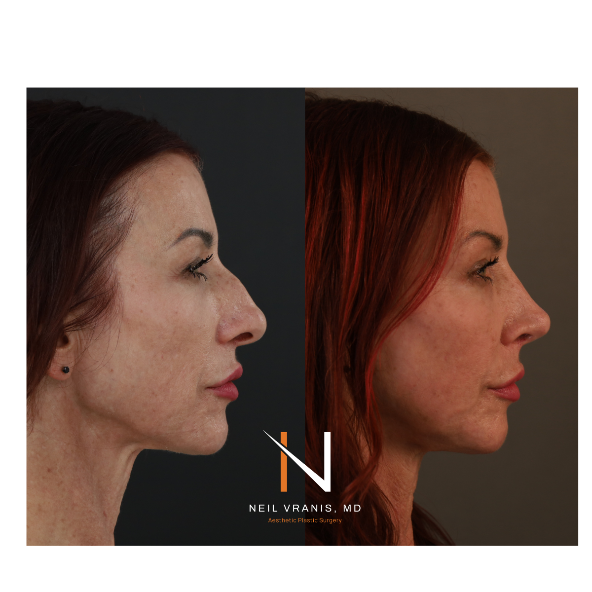 Dr. Neil Vranis Rhinoplasty Before and After Picture