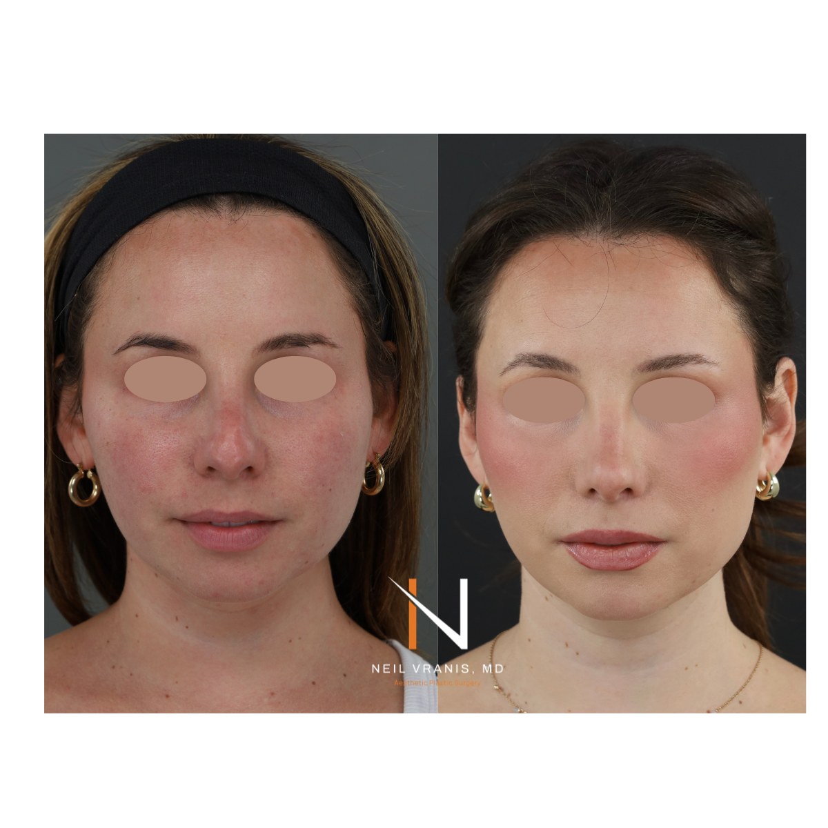 Dr. Neil Vranis Rhinoplasty Before and After Picture