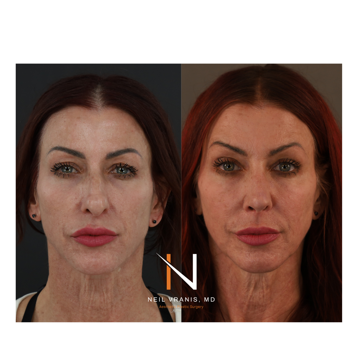 Dr. Neil Vranis Rhinoplasty Before and After Picture